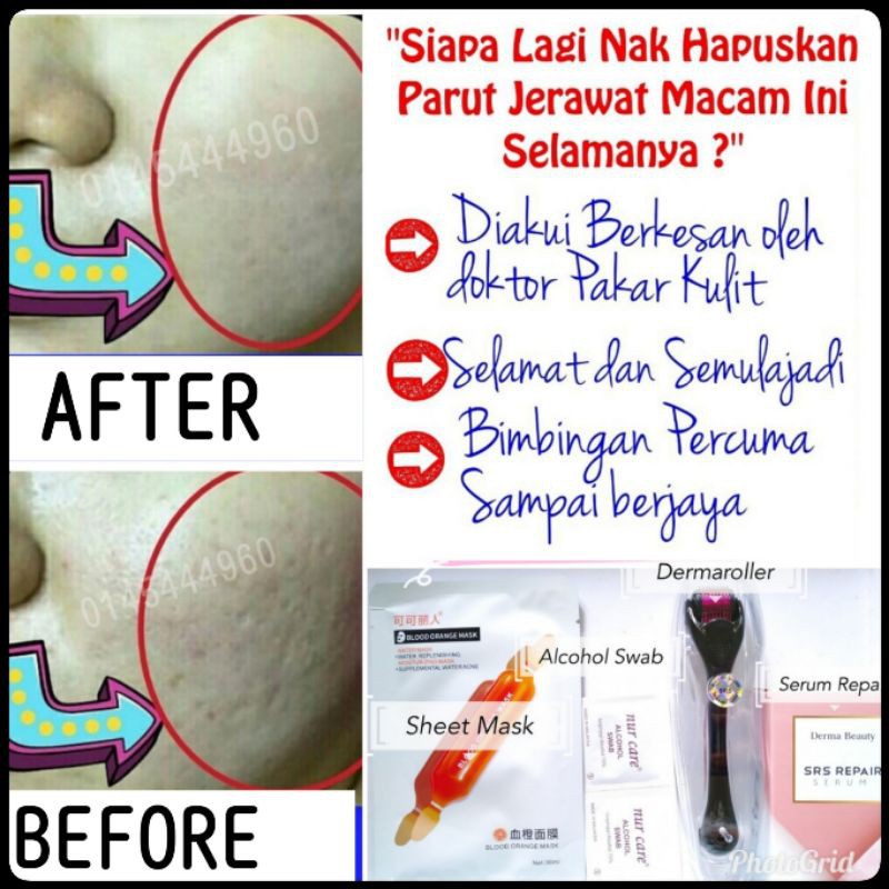 Parut Jerawat Berlubang