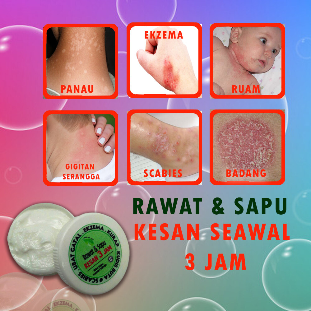 Ubat Gatal Kemaluan Lelaki  30 Ml Krim Ubat Hilang Kegatalan Kulit